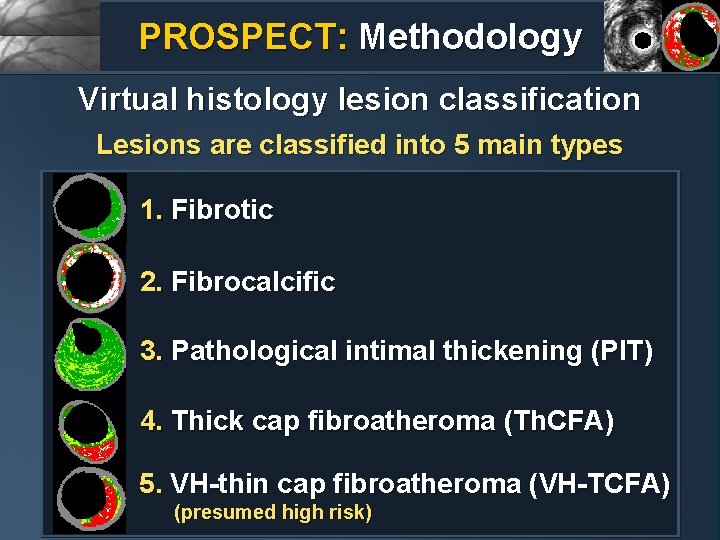 PROSPECT: Methodology Virtual histology lesion classification Lesions are classified into 5 main types 1.