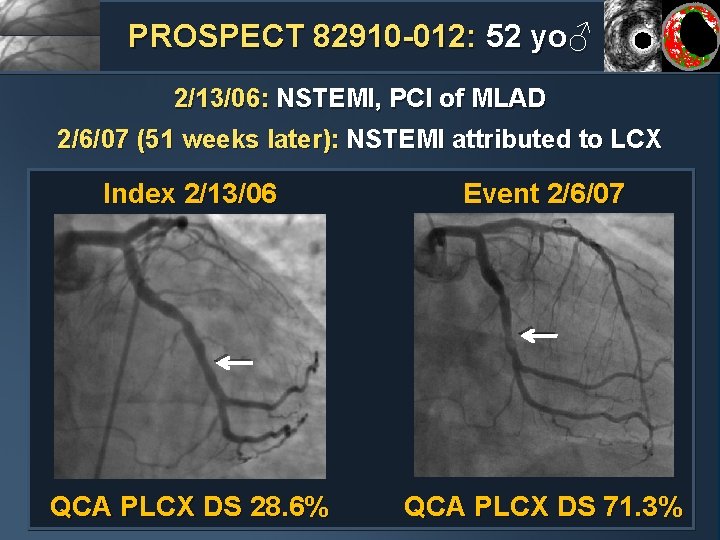 PROSPECT 82910 -012: 52 yo♂ 2/13/06: NSTEMI, PCI of MLAD 2/6/07 (51 weeks later):