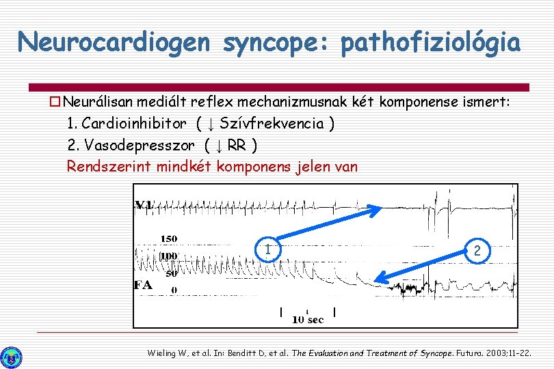 Neurocardiogen syncope: pathofiziológia o. Neurálisan mediált reflex mechanizmusnak két komponense ismert: 1. Cardioinhibitor (