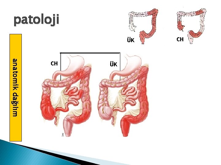 patoloji ÜK a na t o mik d a ğ ıl ım CH CH