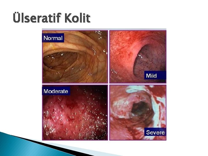 Ülseratif Kolit 