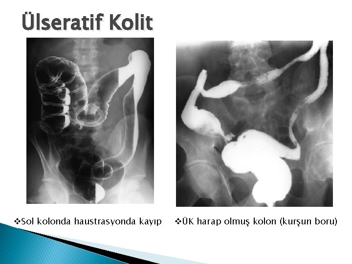 Ülseratif Kolit v. Sol kolonda haustrasyonda kayıp vÜK harap olmuş kolon (kurşun boru) 