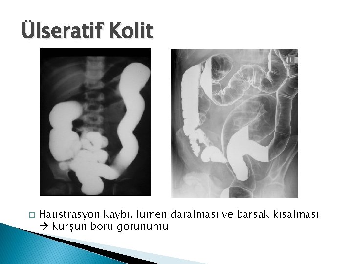 Ülseratif Kolit � Haustrasyon kaybı, lümen daralması ve barsak kısalması Kurşun boru görünümü 