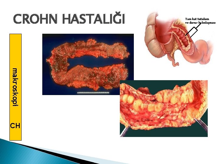 CROHN HASTALIĞI m a k ro s k o p i CH Tam kat