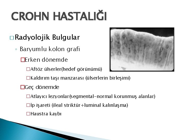 CROHN HASTALIĞI � Radyolojik Bulgular ◦ Baryumlu kolon grafi �Erken dönemde �Aftöz ülserler(hedef görünümü)