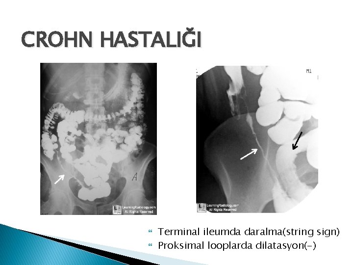 CROHN HASTALIĞI Terminal ileumda daralma(string sign) Proksimal looplarda dilatasyon(-) 
