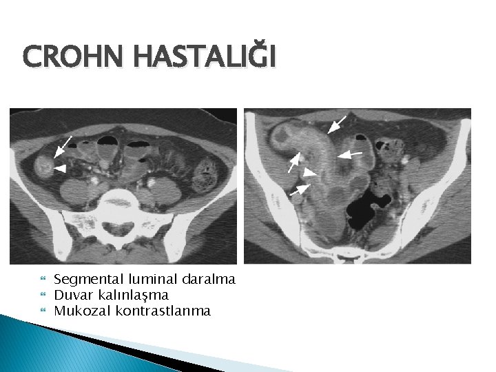 CROHN HASTALIĞI Segmental luminal daralma Duvar kalınlaşma Mukozal kontrastlanma 