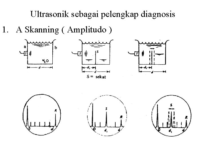 Ultrasonik sebagai pelengkap diagnosis 1. A Skanning ( Amplitudo ) 