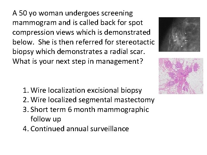 A 50 yo woman undergoes screening mammogram and is called back for spot compression