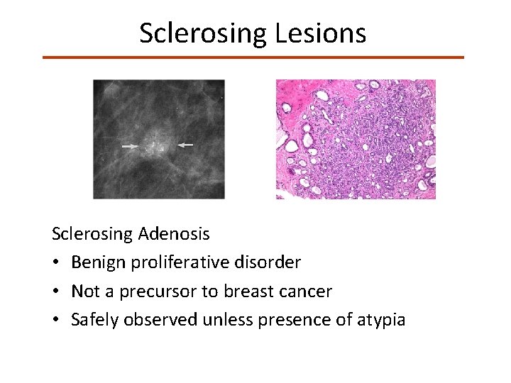 Sclerosing Lesions Sclerosing Adenosis • Benign proliferative disorder • Not a precursor to breast