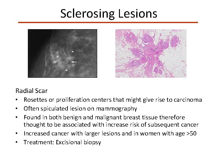 Sclerosing Lesions Radial Scar • Rosettes or proliferation centers that might give rise to