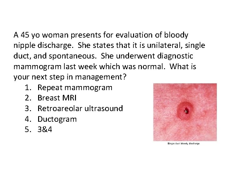 A 45 yo woman presents for evaluation of bloody nipple discharge. She states that