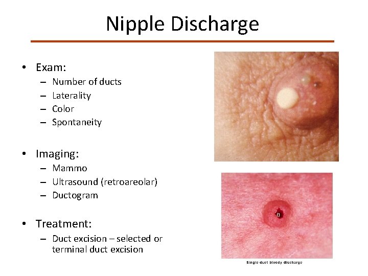 Nipple Discharge • Exam: – – Number of ducts Laterality Color Spontaneity • Imaging: