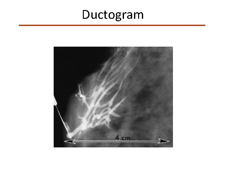 Ductogram 