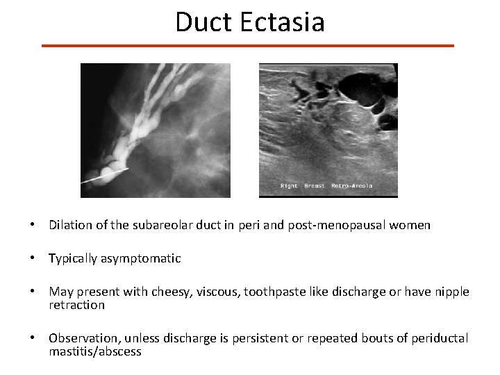 Duct Ectasia • Dilation of the subareolar duct in peri and post-menopausal women •