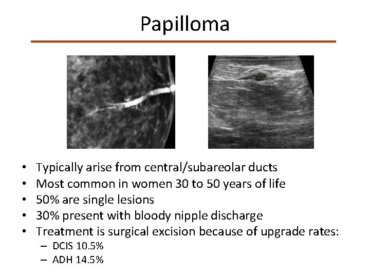 Papilloma • • • Typically arise from central/subareolar ducts Most common in women 30