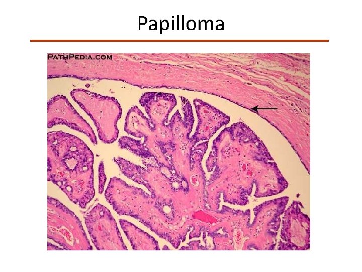Papilloma 