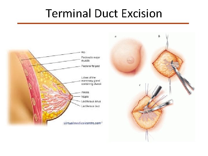 Terminal Duct Excision 