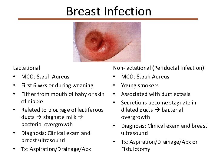 Breast Infection Lactational • MCO: Staph Aureus • First 6 wks or during weaning
