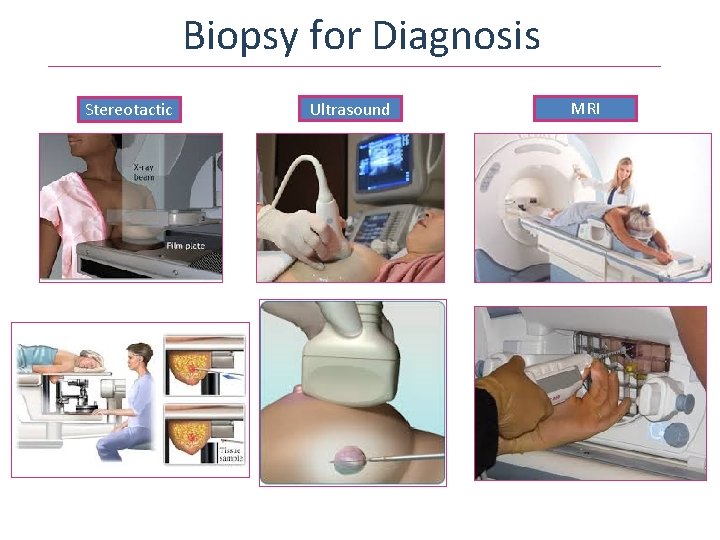 Biopsy for Diagnosis Stereotactic Ultrasound MRI 