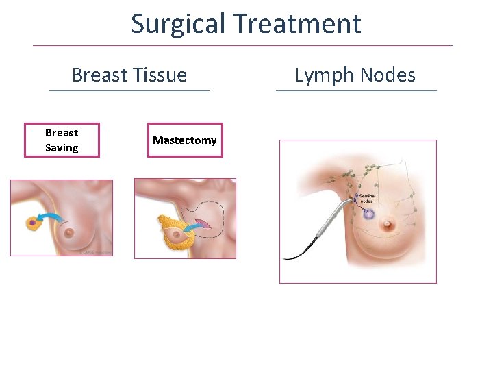 Surgical Treatment Breast Tissue Breast Saving Mastectomy Lymph Nodes 