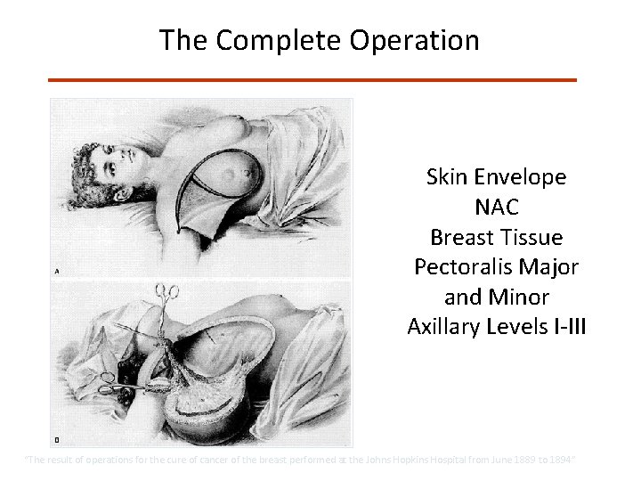 The Complete Operation Skin Envelope NAC Breast Tissue Pectoralis Major and Minor Axillary Levels