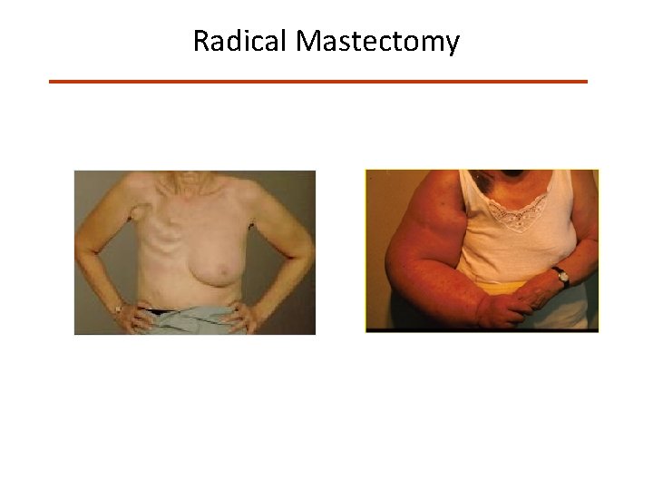 Radical Mastectomy 