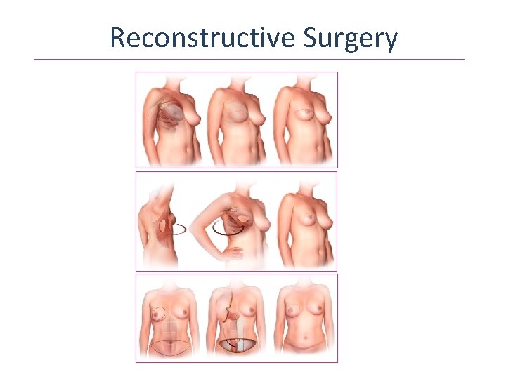 Reconstructive Surgery 