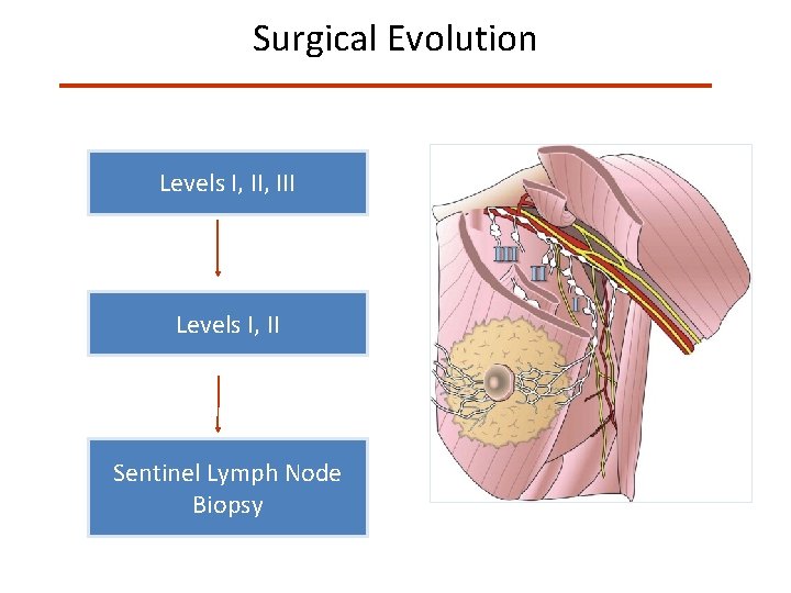 Surgical Evolution Levels I, III Levels I, II Sentinel Lymph Node Biopsy 