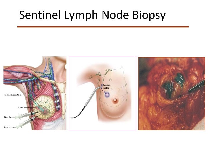 Sentinel Lymph Node Biopsy Giuliano AE. Ann Surg. 1994; 220: 391 -401 