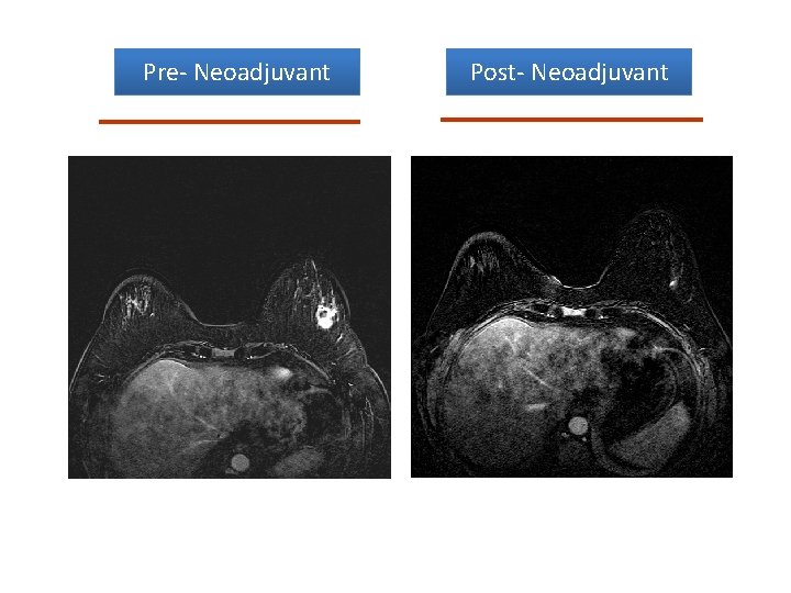 Pre- Neoadjuvant Post- Neoadjuvant 