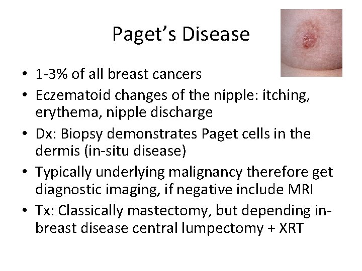 Paget’s Disease • 1 -3% of all breast cancers • Eczematoid changes of the