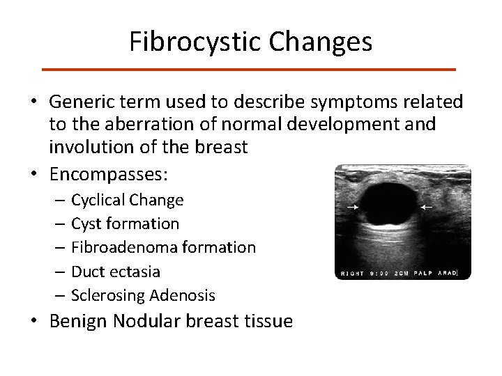 Fibrocystic Changes • Generic term used to describe symptoms related to the aberration of