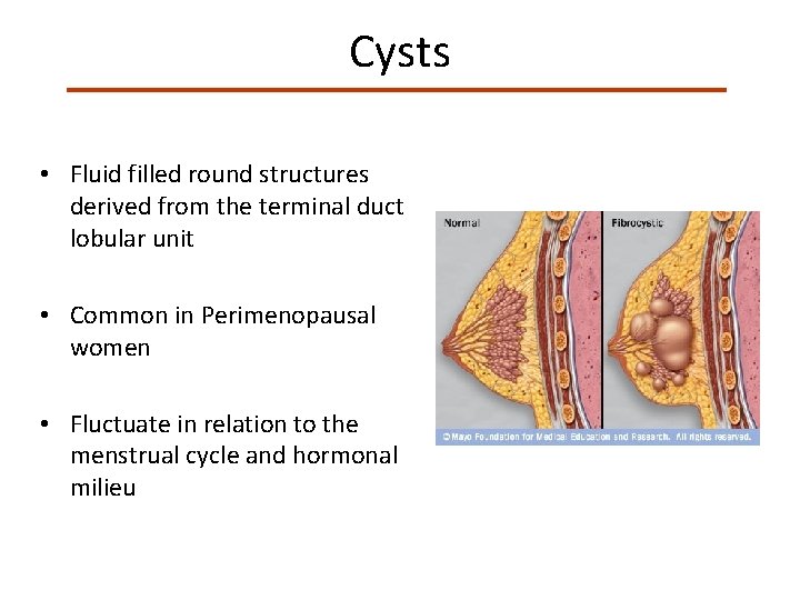 Cysts • Fluid filled round structures derived from the terminal duct lobular unit •