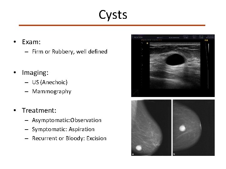 Cysts • Exam: – Firm or Rubbery, well defined • Imaging: – US (Anechoic)