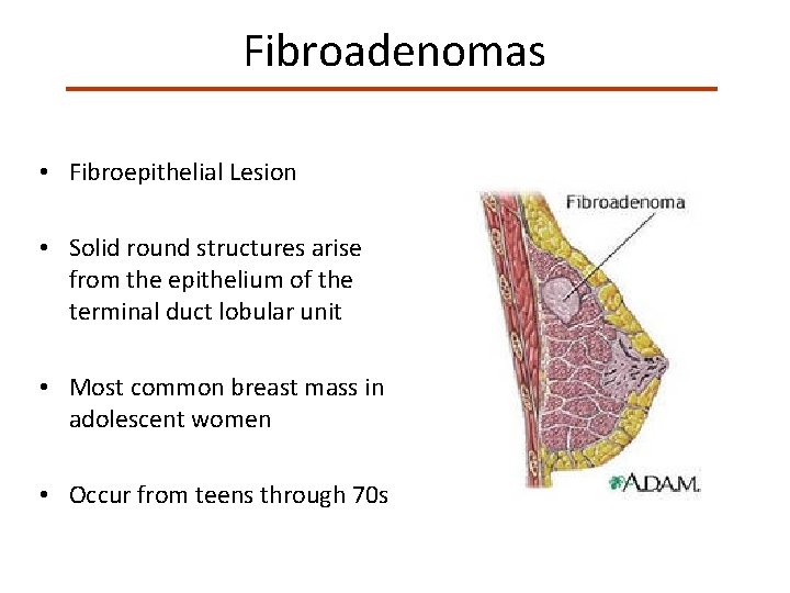 Fibroadenomas • Fibroepithelial Lesion • Solid round structures arise from the epithelium of the