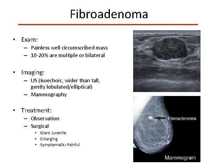 Fibroadenoma • Exam: – Painless well circumscribed mass – 10 -20% are multiple or