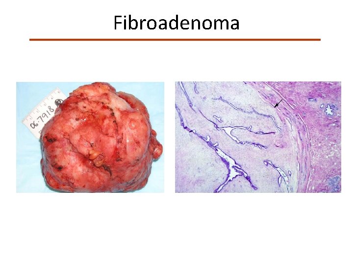 Fibroadenoma 