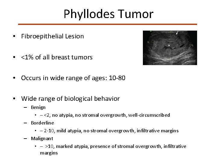Phyllodes Tumor • Fibroepithelial Lesion • <1% of all breast tumors • Occurs in