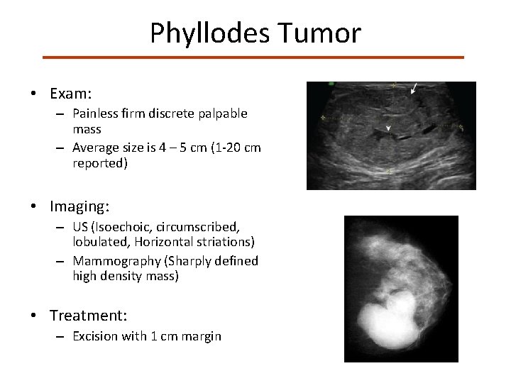 Phyllodes Tumor • Exam: – Painless firm discrete palpable mass – Average size is