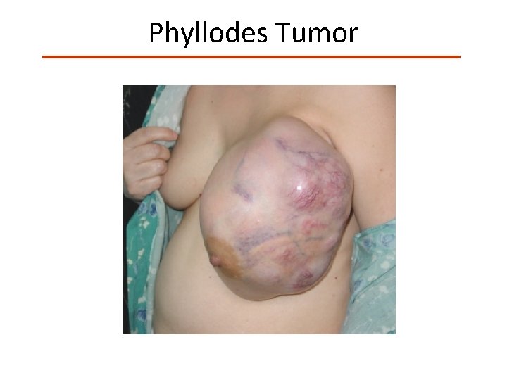 Phyllodes Tumor 