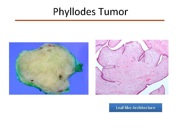 Phyllodes Tumor Leaf-like Architecture 