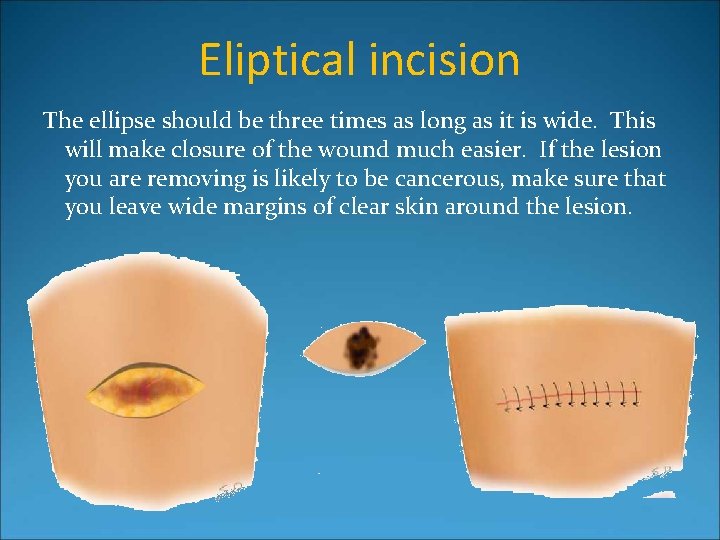 Eliptical incision The ellipse should be three times as long as it is wide.