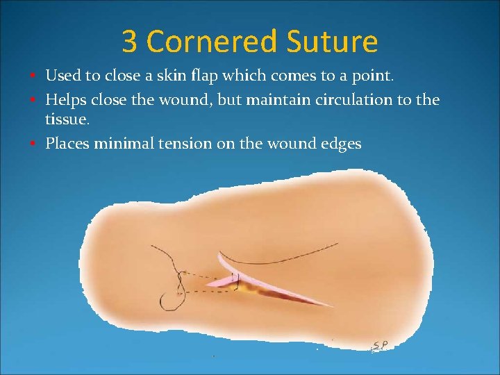 3 Cornered Suture • Used to close a skin flap which comes to a