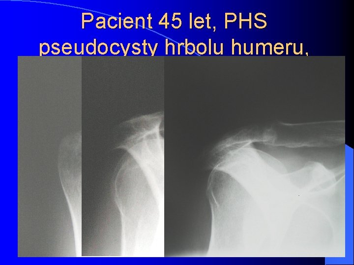 Pacient 45 let, PHS pseudocysty hrbolu humeru, artrotické změny AC kloubu, subakrom. prost. ,