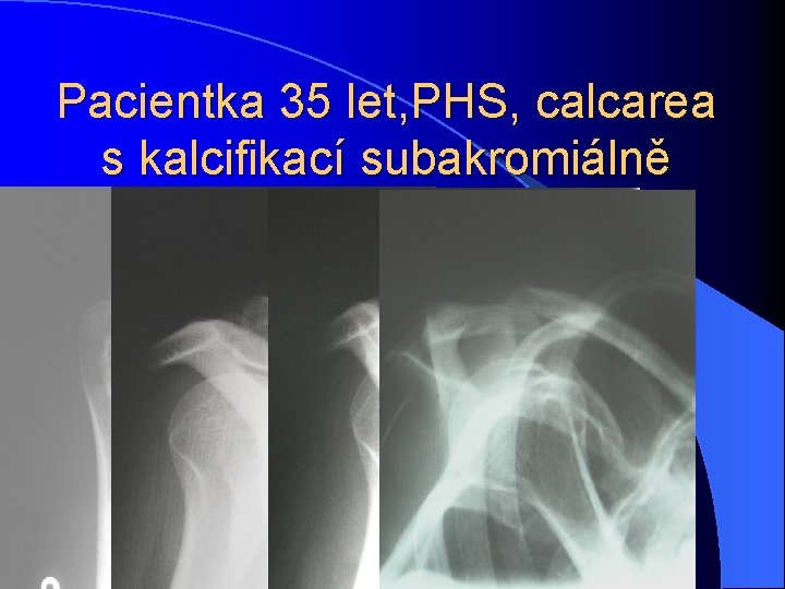 Pacientka 35 let, PHS, calcarea s kalcifikací subakromiálně velikosti 7 x 4 mm 