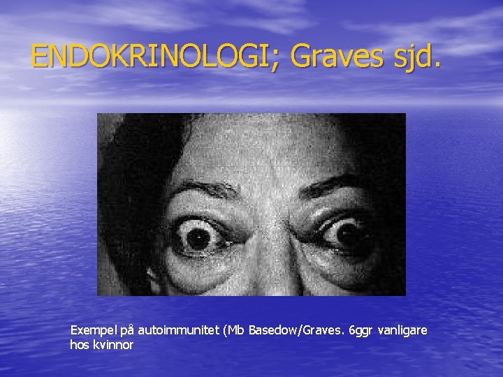 ENDOKRINOLOGI; Graves sjd. Exempel på autoimmunitet (Mb Basedow/Graves. 6 ggr vanligare hos kvinnor 