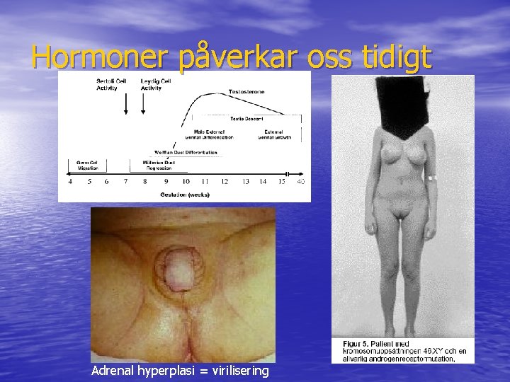 Hormoner påverkar oss tidigt Adrenal hyperplasi = virilisering 