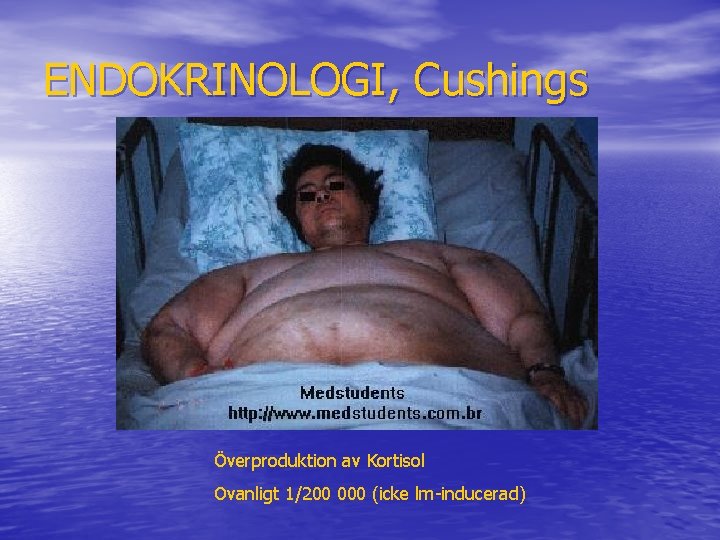 ENDOKRINOLOGI, Cushings Överproduktion av Kortisol Ovanligt 1/200 000 (icke lm-inducerad) 