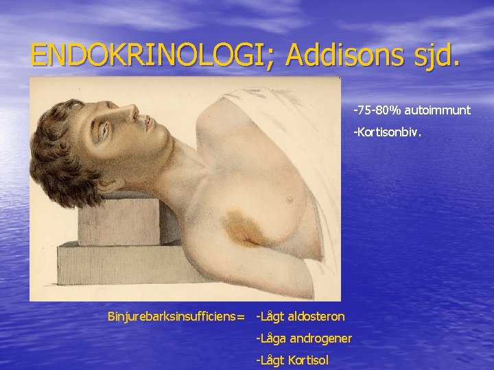 ENDOKRINOLOGI; Addisons sjd. -75 -80% autoimmunt -Kortisonbiv. Binjurebarksinsufficiens= -Lågt aldosteron -Låga androgener -Lågt Kortisol
